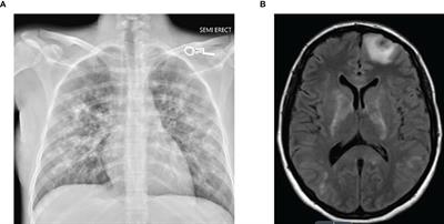 Case Report: Use of Obinutuzumab as an Alternative Monoclonal Anti-CD20 Antibody in a Patient With Refractory Immune Thrombocytopenia Complicated by Rituximab-Induced Serum Sickness and Anti-Rituximab Antibodies